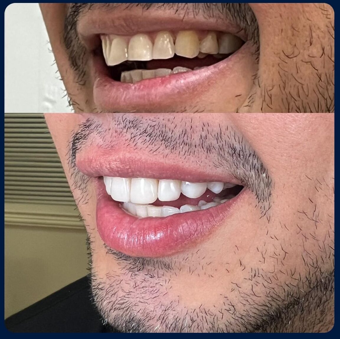 Dra Nicolle Paulucci, Invisalign Campo Grande, Protocolo completo