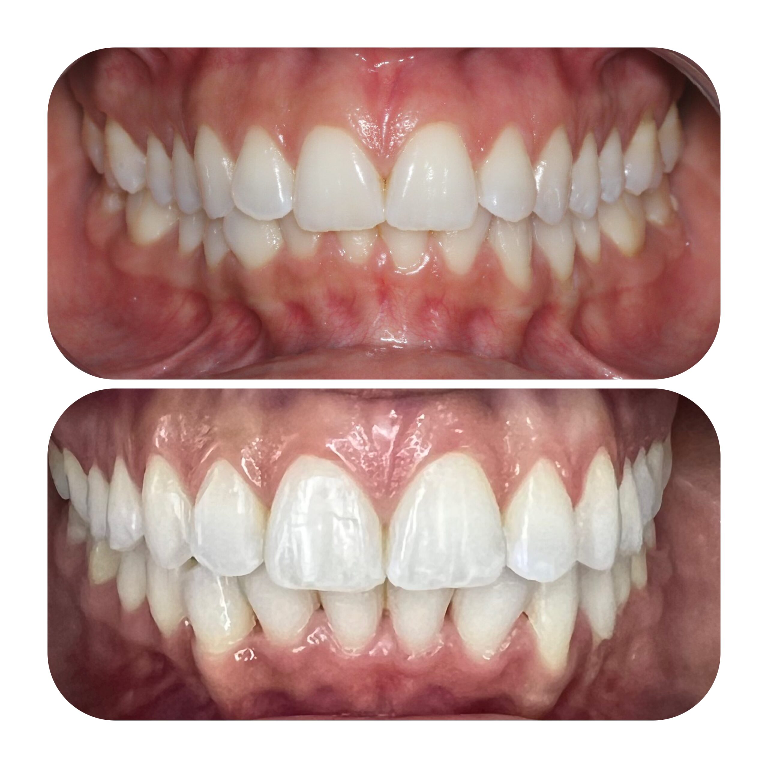 Dra Nicolle Paulucci, Invisalign Campo Grande, Protocolo completo