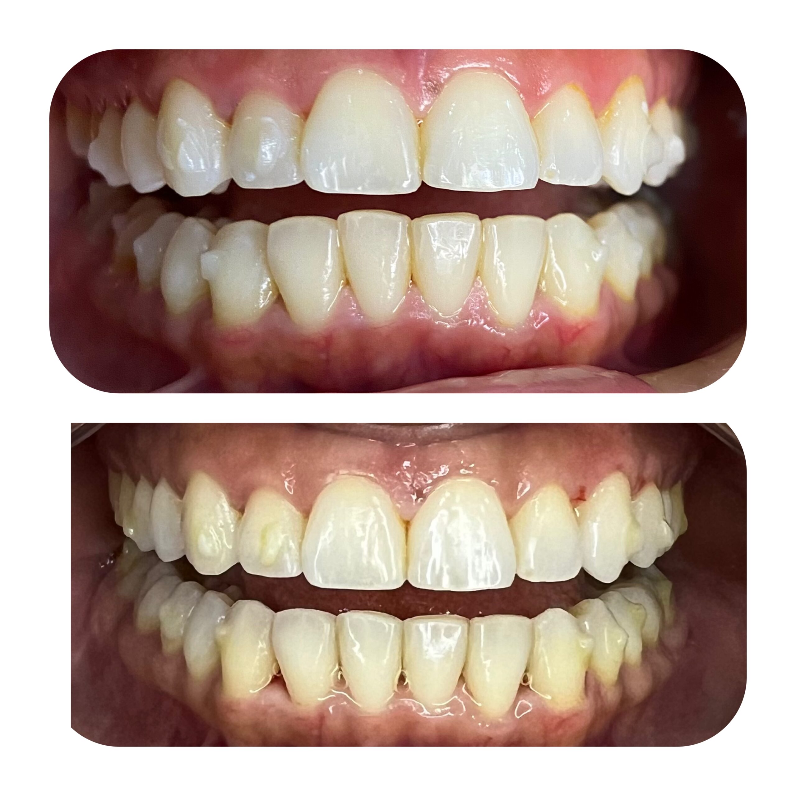 Dra Nicolle Paulucci, Invisalign Campo Grande, Protocolo completo